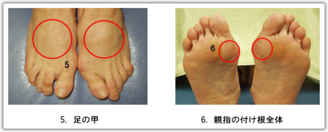 足 の 親指 の 付け根 が 痛い テーピング